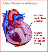L’insuffisance cardiaque